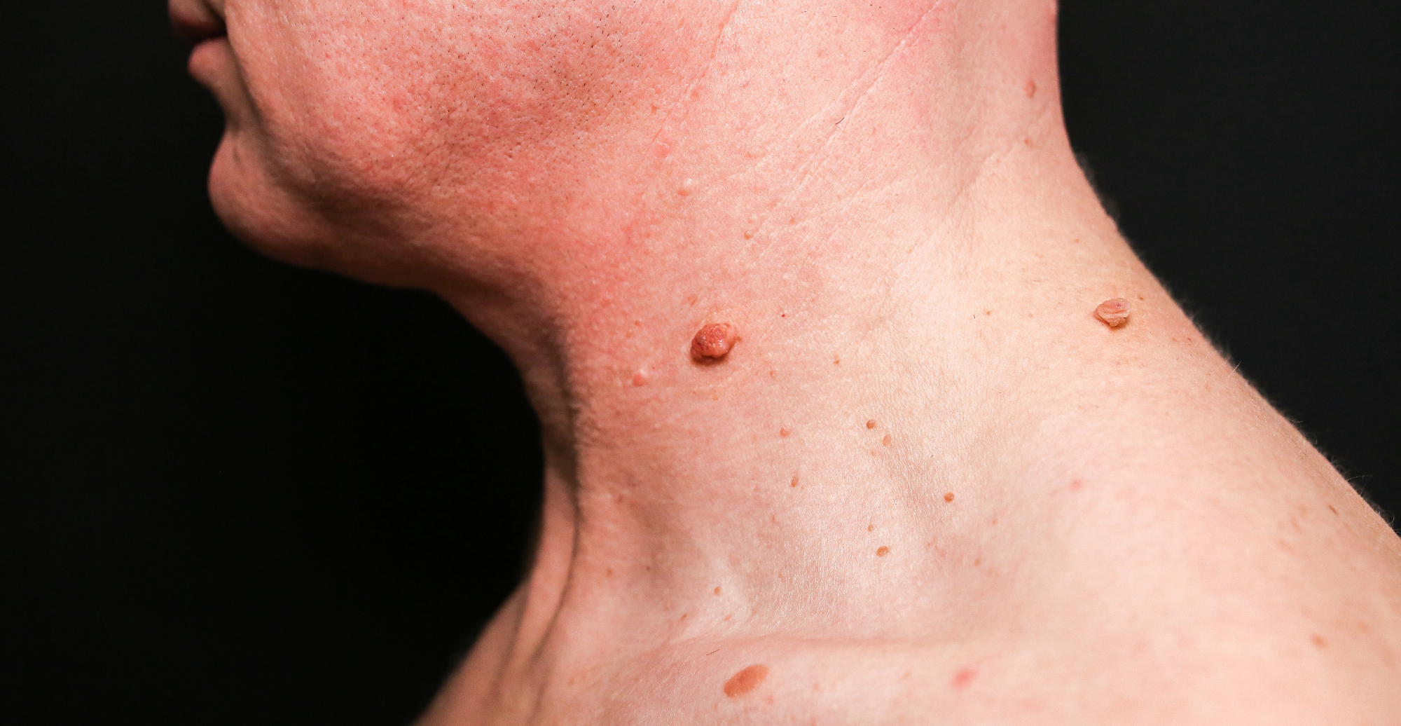 Odstranitev znamenja kot preventiva